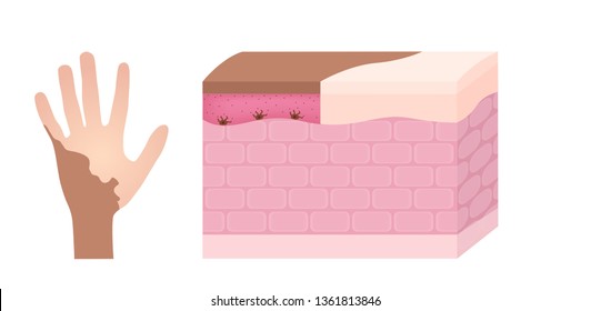 vitiligo on skin layer anatomy vector / melanin
