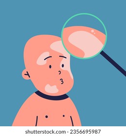 Vitiligo people. Child with white pigment spots on his face at an appointment with a doctor who looks at the skin through a magnifying glass. World Vitiligo Day. Flat vector illustration.