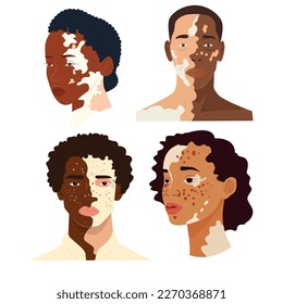 Vitiligo people Flat vector stock illustration. The concept of different beauty, body positive, self-acceptance. Men, women, vitiligo skin disease. Vitiligo skin illustration with people