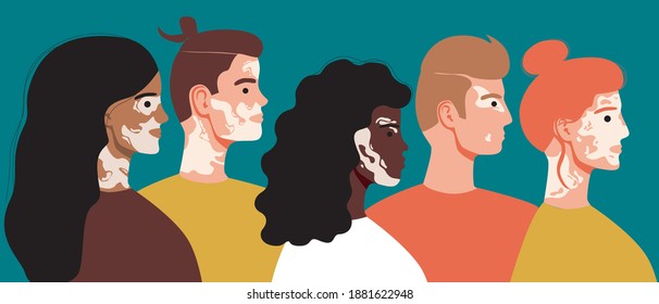 Vitiligo people isolated. Flat vector stock illustration. The concept of different beauty, body positive, self-acceptance. Men, women, vitiligo skin disease. Vitiligo skin illustration with people