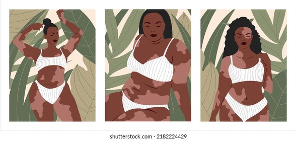 Vitiligo people isolated. Flat vector stock illustration. The concept of different beauty, body positive, self-acceptance. Men, women, vitiligo skin disease. Vitiligo skin illustration with people