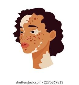 Vitiligo people isolated. Flat vector stock illustration. The concept of different beauty, body positive, self-acceptance.  women, vitiligo skin disease. Vitiligo skin illustration with people