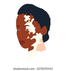 La gente de Vitiligo aislada. Ilustración de material vectorial plano. El concepto de belleza diferente, cuerpo positivo, autoaceptación.  mujeres, enfermedad de la piel de vitiligo. Ilustración cutánea de Vitiligo con personas