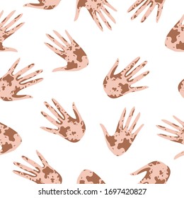 Vitiligo seamless pattern of Hands High five. Pattern with hands with different skin color and nationality. Pattern of friendship of peoples all over the world. Vector illustration. A pattern about