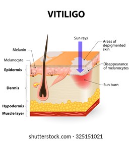 Vitiligo. Is a skin condition characterized by portions of the skin losing their pigment. It occurs when skin pigment cells (melanocytes) die or are unable to function.