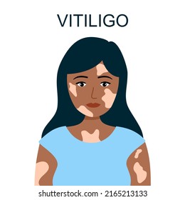 Vitiligo skin disease concept vector illustration. Woman with skin problem.