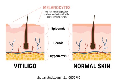 Vitiligo skin disease and healthy skin infographic. Skin anatomy. Melanocytes stop producing melanin. Flat vector illustration 