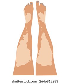 vitiligo skin legs.vitiligo skin disease