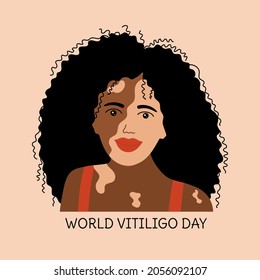 Vitiligo. Smiling girl with skin problems. World vitiligo day. Skin disease. Accepting oneself. Self love. Woman with curly black hair