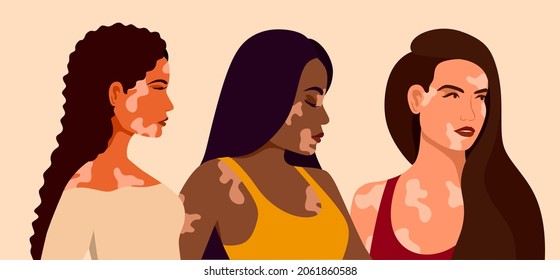 Vitiligo tres jóvenes de diferentes razas con problemas cutáneos. Enfermedades cutáneas. El concepto del Día Mundial del Vitiligo. Diferentes colores de piel de personajes femeninos. Para un blog, artículos, banner, revista.