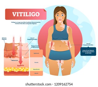 Vitiligo vector illustration. White pigment autoimmune disease with pigment loss. Skin depigmentation and genetic illness. Diagram with epidermis, dermis, hypodermis and muscle.