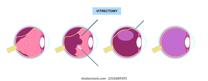 Chirurgische Vitrektomie. Augenklinik, entfernen Sie das glasartige Gel aus dem Auge, Behandlung der Netzhautablösung, makularen Löcher oder Glaskörperblutung, Verbesserung der Vision flache Vektorgrafik