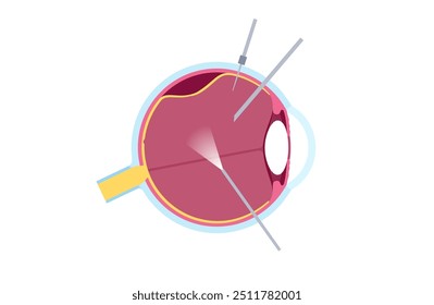 Chirurgische Vitrektomie. Augenklinik, entfernen Sie das glasartige Gel aus dem Auge, Behandlung der Netzhautablösung, makularen Löcher oder Glaskörperblutung, Verbesserung der Vision flache Vektorgrafik