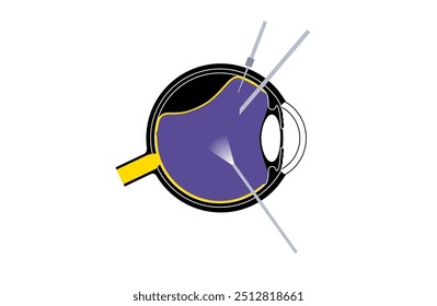 Procedimento cirúrgico de vitrectomia. Clínica oftalmológica, remover o gel vítreo do olho, tratar o descolamento da retina, buracos maculares ou hemorragia vítrea, melhorando a visão ilustração do vetor plano