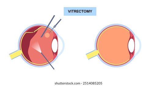 Procedimento cirúrgico de vitrectomia. Clínica oftalmológica, remover o gel vítreo do olho, tratar o descolamento da retina, buracos maculares ou hemorragia vítrea, melhorando a visão ilustração do vetor plano