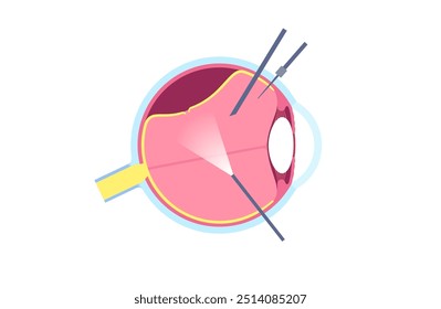 Procedimento cirúrgico de vitrectomia. Clínica oftalmológica, remover o gel vítreo do olho, tratar o descolamento da retina, buracos maculares ou hemorragia vítrea, melhorando a visão ilustração do vetor plano