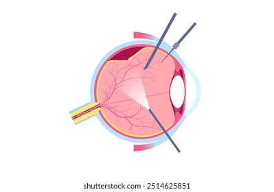 Procedimento cirúrgico de vitrectomia. Clínica oftalmológica, remover o gel vítreo do olho, tratar o descolamento da retina, buracos maculares ou hemorragia vítrea, melhorando a visão ilustração do vetor plano