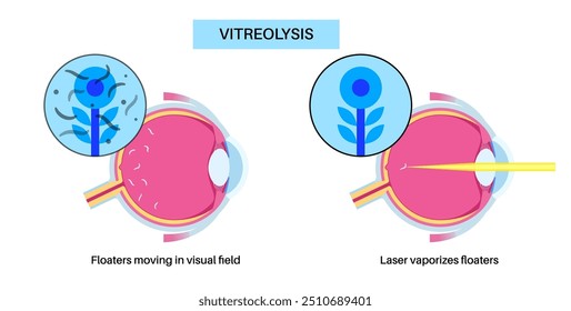 Tratamento com laser de vitreólise. Laser YAG, usado em oftalmologia para reduzir os flutuadores oculares, visando opacidades vítreas. Procedimento seguro e eficaz, melhora a clareza visual, ilustração do vetor médico