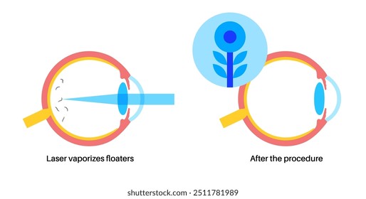 Vitreolyse-Laserbehandlung. YAG-Laser, der in der Augenheilkunde eingesetzt wird, um Augenschwimmer zu reduzieren, indem er auf Glaskörpertrübungen abzielt. Sicheres und effektives Verfahren, verbesserte optische Klarheit, medizinische Vektorgrafik