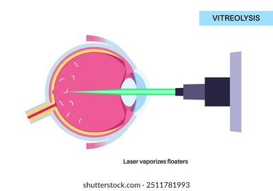 Vitreolyse-Laserbehandlung. YAG-Laser, der in der Augenheilkunde eingesetzt wird, um Augenschwimmer zu reduzieren, indem er auf Glaskörpertrübungen abzielt. Sicheres und effektives Verfahren, verbesserte optische Klarheit, medizinische Vektorgrafik