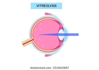 Vitreolyse-Laserbehandlung. YAG-Laser, der in der Augenheilkunde eingesetzt wird, um Augenschwimmer zu reduzieren, indem er auf Glaskörpertrübungen abzielt. Sicheres und effektives Verfahren, verbesserte optische Klarheit, medizinische Vektorgrafik