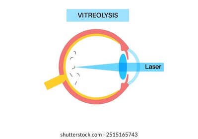 Vitreolyse-Laserbehandlung. YAG-Laser, der in der Augenheilkunde eingesetzt wird, um Augenschwimmer zu reduzieren, indem er auf Glaskörpertrübungen abzielt. Sicheres und effektives Verfahren, verbesserte optische Klarheit, medizinische Vektorgrafik