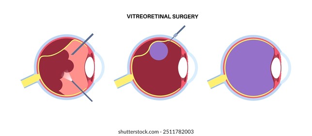 Vitreoretinale Chirurgie. Verfahren auf der Netzhaut, Behandlung von Netzhautablösung, Makulaöchern und diabetischer Retinopathie, die Vitrektomie und Laserintervention zur Wiederherstellung der Vektorgrafik erfordern