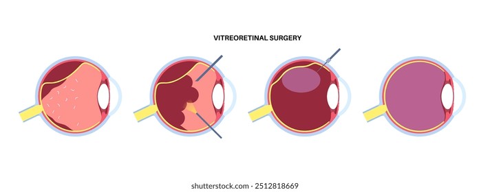 Vitreoretinal surgery. Procedure on the retina, treating retinal detachment, macular holes, and diabetic retinopathy, requiring vitrectomy and laser intervention to restore vision vector illustration