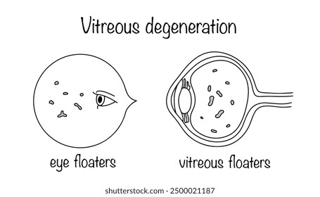 Vitreous degeneration. The appearance of inclusions in the vitreous body. The patient sees spots, threads, cobwebs, and “flies” in the field of vision. Human eye disease.