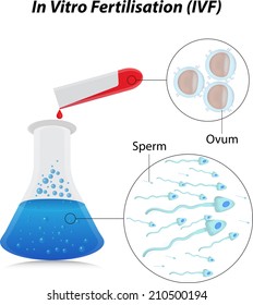 In Vitro Fertilisation