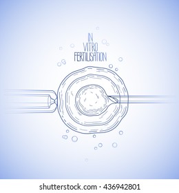 In vitro fertilisation. Artificial insemination. Graphic medical illustration. Vector design in blue colors