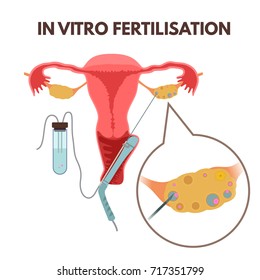 In vitro fertilisation method - transvaginal oocyte retrieval