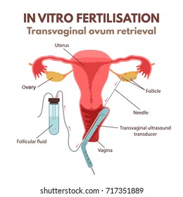 In vitro fertilisation method - transvaginal oocyte retrieval