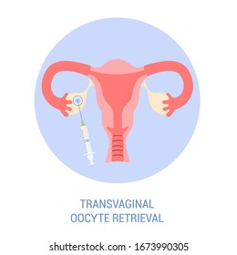 In vitro fertilisation step. Removing oocyte from the ovary of a woman, enabling fertilization outside the body. Artificial pregnancy with help of modern technology. Isolated illustration