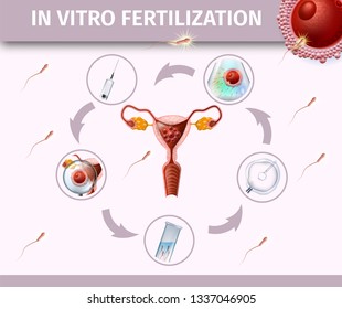 In Vitro Fertilization Colored Poster with Front View of Uterus in Center Surrounded with IVF Icons of Stages. Spermatozoons Flowing Towards Female Egg Cell. Vector Realistic Illustration, Banner.