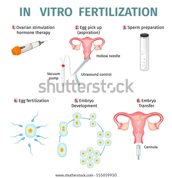 Vitro Fertilization Concept Steps Procedures Artificial Stock Vector Royalty Free 555059950 7915