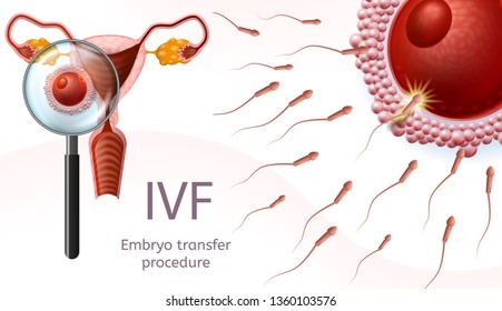 In Vitro Fertilization. Embryo Transfer Procedure. Female Uretus and Sperm Flow to Egg Cell. Magnifier Glass View. Reproductive Human System IVF Vector Realistic Illustration. Banner for Medical Use