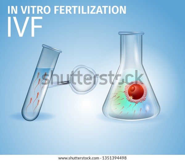 体外受精 ヒトの受精卵を研究室のビーカーの中で受精 卵子に針 試験管に精子 不妊症治療ivf細胞質内の方法 リアルなベクターイラストバナー のベクター画像素材 ロイヤリティフリー