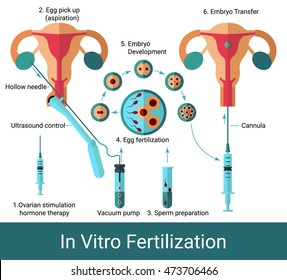 Gráfico infográfico de fertilização in vitro em estilo plano. Esquema de inseminação artificial. Ultrassom do útero. Fertilização do ovo. Desenvolvimento embrionário. EPS 10 ilustração vetorial. Isolado.