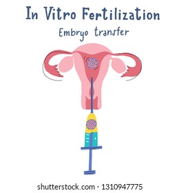 In vitro fertilization infographic in flat and handdrawn style with hand lettering. Scheme of artificial insemination. Embryo transfer. Vector illustration for scientific manual 