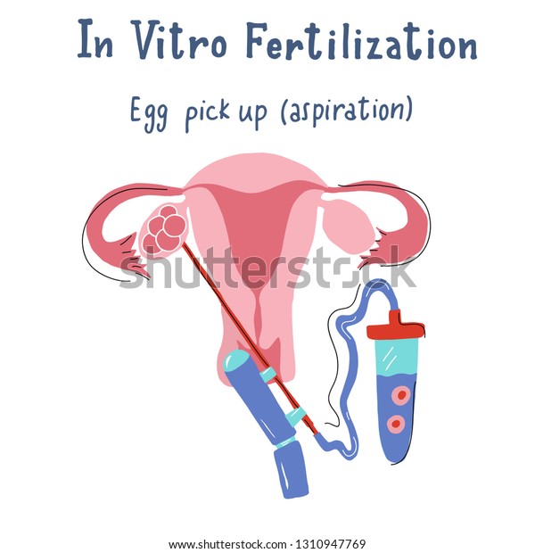 Vitro Fertilization Infographic Flat Handdrawn Style เวกเตอร์สต็อก ปลอดค่าลิขสิทธิ์ 