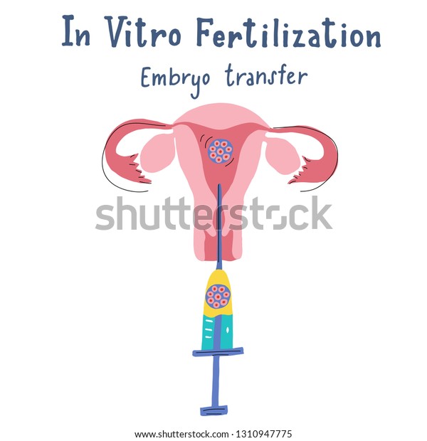 Vitro Fertilization Infographic Flat Handdrawn Style Stock Vector Royalty Free 1310947775 