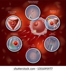 In Vitro Fertilization Infographics. Fertilizing Process by Manually Combining Egg and Sperm in Lab Dish, and then Embryo Transferring to Uterus. Vector Realistic Illustration. IVF Medical Banner.