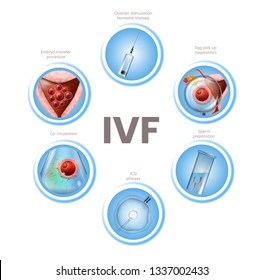 In Vitro Fertilization Infographics. Labeled Round Icons of IVF Stages Isolated on White Background. Human Assisted Reproductive Technology. Vector Realistic Illustration. Medical Educational Banner