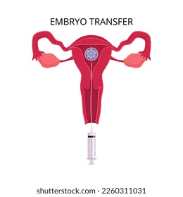 Fertilización in vitro con composición plana con subtítulos de texto e iconos de inseminación artificial ilustración vectorial