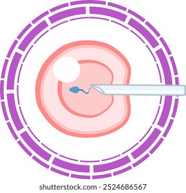 Fertilização in vitro Infográfico médico e esquema de tratamento de infertilidade. Hiperestimulação ovárica, inseminação artificial, cultura de embriões e criopreservação. Procedimento médico para a gravidez