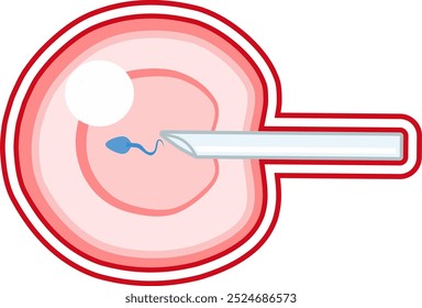 Fertilização in vitro Infográfico médico e esquema de tratamento de infertilidade. Hiperestimulação ovárica, inseminação artificial, cultura de embriões e criopreservação. Procedimento médico para a gravidez