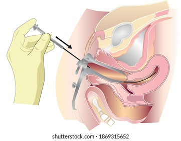 In vitro fertilization (IVF) Procedure