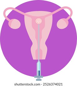 Fecundación in vitro Infografía de Vector de FIV y esquema de tratamiento de infertilidad. Hiperestimulación ovárica, inseminación artificial, cultivo embrionario y criopreservación. Procedimiento médico para el embarazo