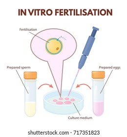 In vitro fertilization method - Co-incubation. Sperm and the egg are incubated in the laboratory